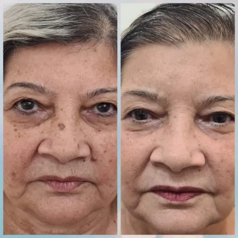 Estética Facial