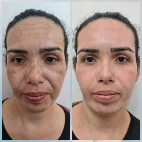 Estética Facial