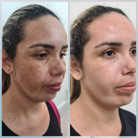 Estética Facial