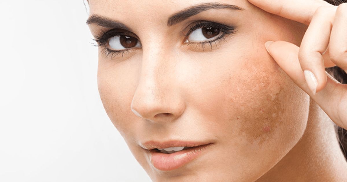 Imagem de capa: Melasma: o que é e como tratar do jeito certo