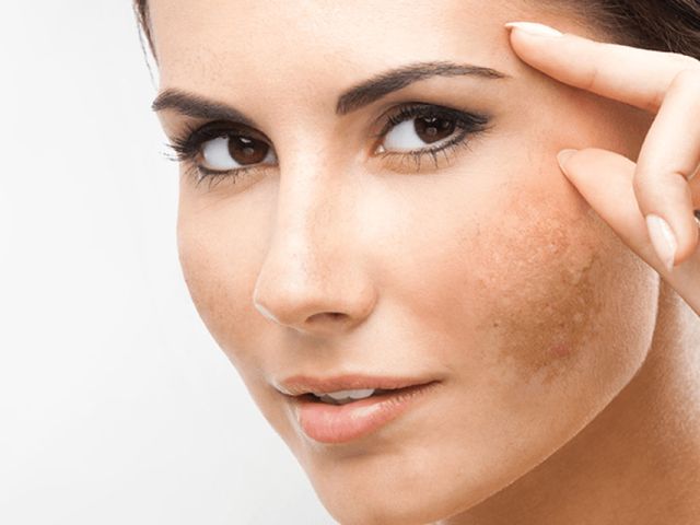 Melasma: o que é e como tratar do jeito certo