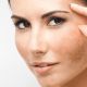 Melasma: o que é e como tratar do jeito certo