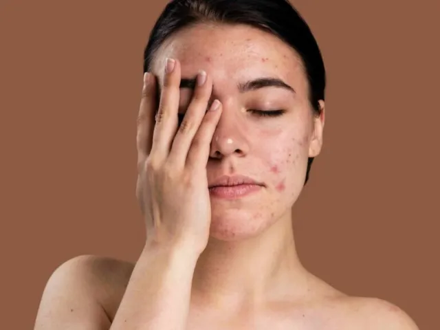 Tratamento para Acne