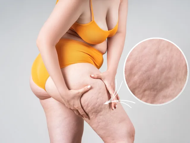 Tratamento para Lipedema